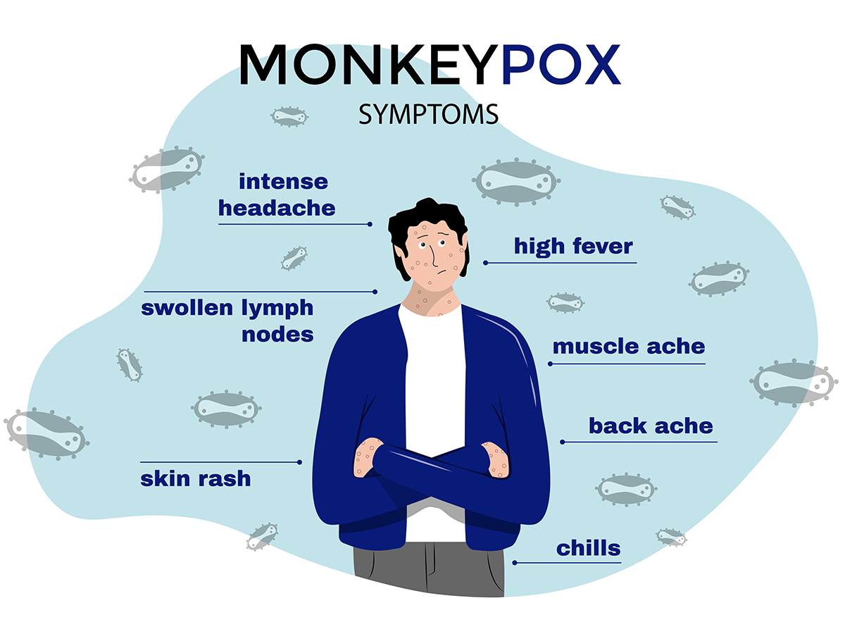 What You Need to Know About Monkeypox