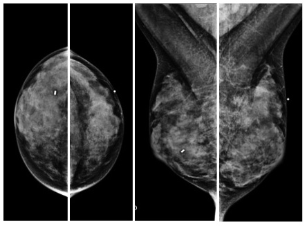 Mammogram result highlighting breast cancer tumor