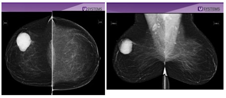 Mammogram result highlighting large breast cancer tumor